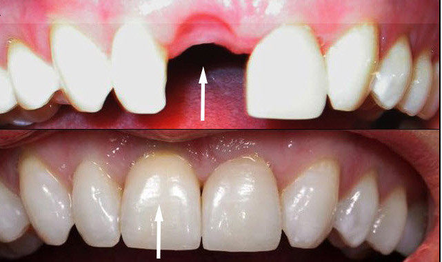 inainte-si-dupa-implant-dentar-estetica