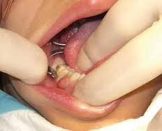 infectie dentara