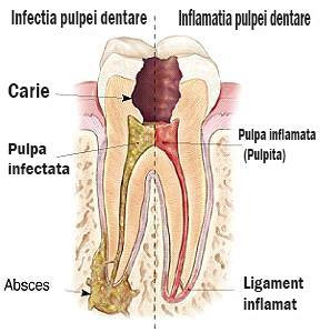 inflamatie si infectie dentara