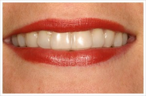 invisalign