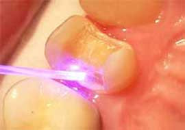 laser dinti