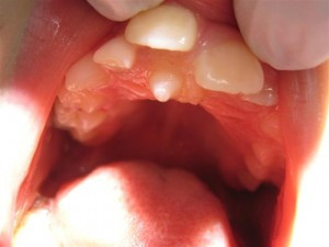meziodens-prekobrojni-zub-smješten-između-gornjih-središnjih-sjekutića