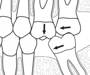 migrare dentara