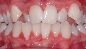 modificari dentare de pozitie