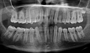 molar 3 absent