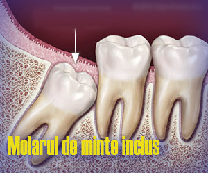 molar de minte inclus