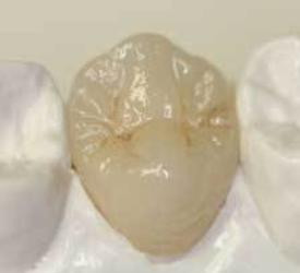 premolar ceramica