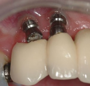 probleme implant dentar
