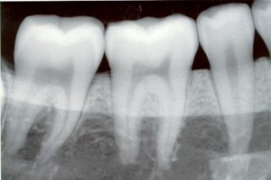 radiografie dentara