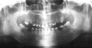 radiografie dentinogeneza imperfecta