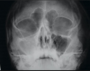 radiografie sinus