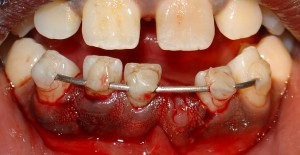 replantarea dentara