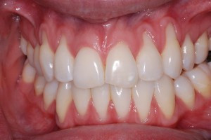 retractie gingivala