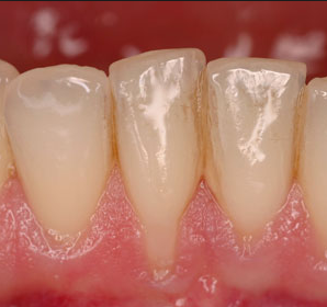 retractie gingivala