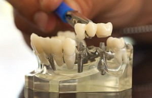 siguranta implanturi dentare