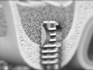 sinus si implant dentar