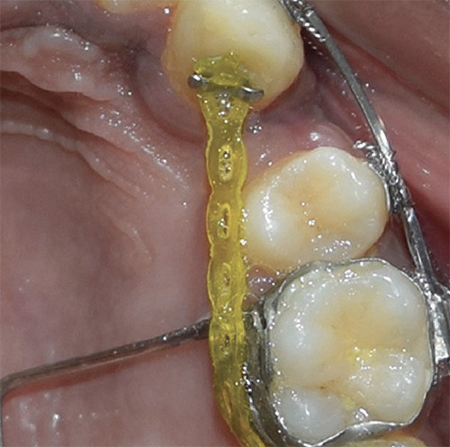 Buton tip clema dubla cu aripioare