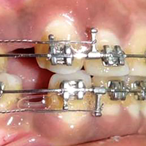 Carlige bidirectionale crimpabile in cadrul tratamentului ortodontic