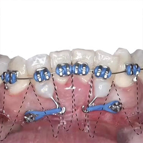 Carlige ortodontice colabile