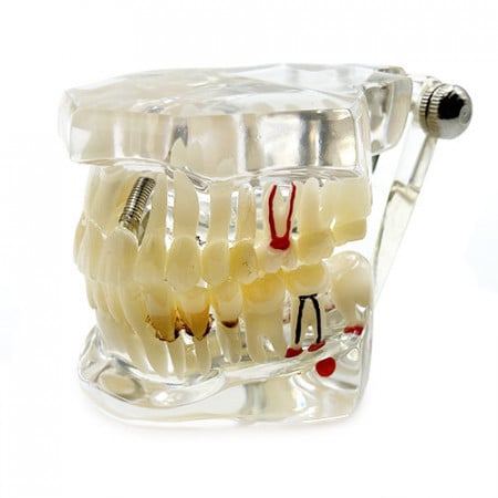 Model patologii si implanturi dentare YL-C15