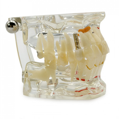 Model patologii si implant dentar YL-C2