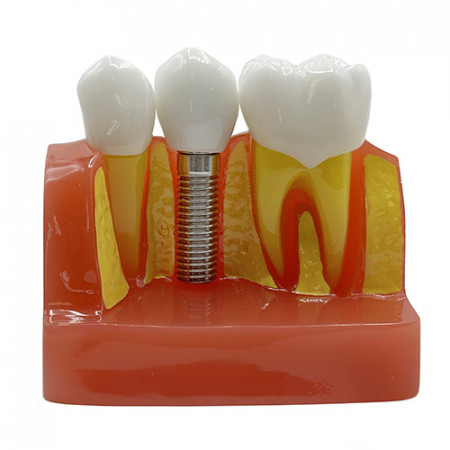 Model educational implant dentar YL-M3