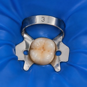 Clema Diga Glossy Nr 3 Molari Inferiori Ultria