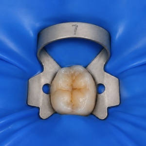 Clema De Diga Molari Inferiori #7 Cu Aripioare Mata