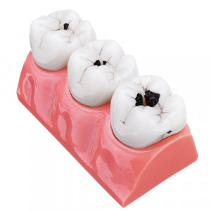 Model educational evolutia cariei dentare in molari