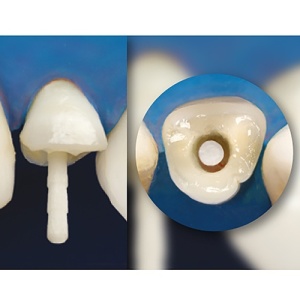 Pivoti de sticla Reforpin universal 10buc