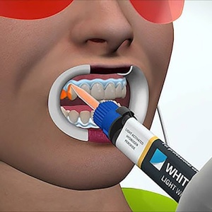 WHITE SMILE POWER WHITENING YF 40