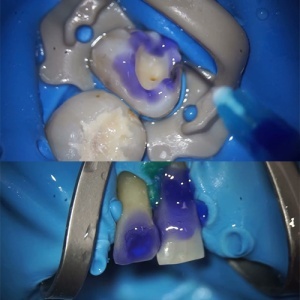 Gel Demineralizant Etchgel Tip Seringa 2.6g Arkona