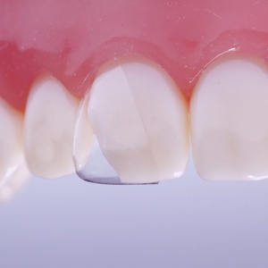 Kit Coroane dentare Transparente Frontali 1.910 64buc