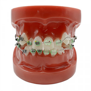 Model educational ortodontic aparat dentar metalic si ceramic