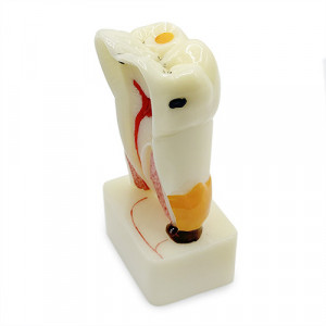 Model educational patologii dentare corono-radiculare YL-C17