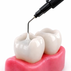 Nexcomp Flow 2 x 2g Meta-Biomed tooth