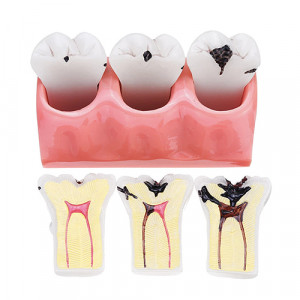 Model educatie pacienti evolutia cariei dentare in molari