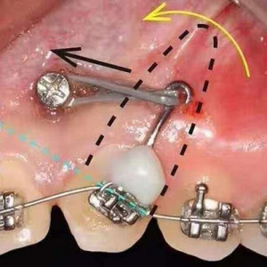 Carlig ortodontic colabil power arm pe mini implant