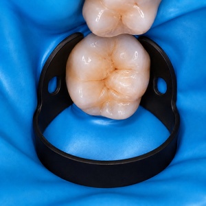 Clema Diga Molari Superiori #W14A TitaniumBlack Ultria