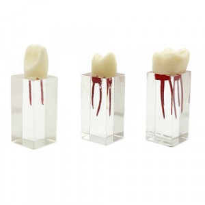 Endo block transparent cu coroana YL-N5 3buc