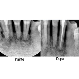 Hidroxid de Calciu Viopaste Seringa 2g Spident