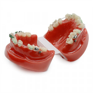 Model educational ortodontie aparat dentar