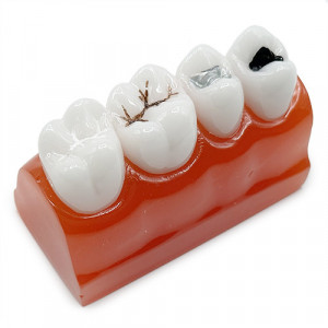 Model educational tipuri de sigilari dentare YL-M10
