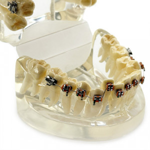 Model dentar ortodontic transparent canin ectopic YL-B5-01