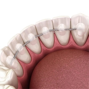 Arc lingual impletit de contentie .03222 18cm