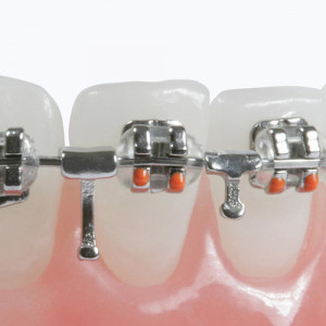 Carlige ortodontice crimpabile bidirectionale