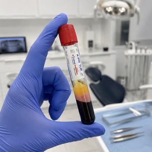 Eprubete A-PRF Vacutainer 10 ml Keymed 100buc - Img 3
