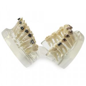 Model transparent canin ectopic cu aparat dentar YL-B5-01