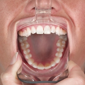 Oglinda fotografie dentara 2 fete G2 oclusal adult
