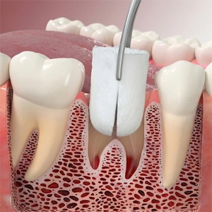 Colla Plug Pansamente Hemostatic Colagen 10 buc